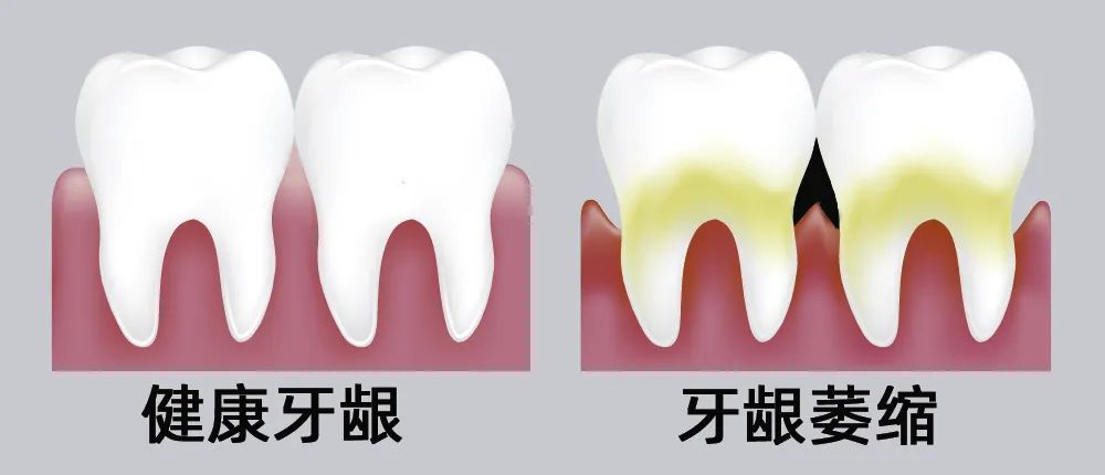 牙縫大露出“黑三角”，既塞牙又難看！還能恢復(fù)嗎？